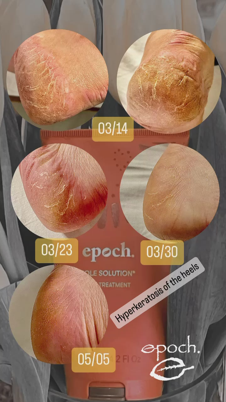Epoch Sole Solution Foot Treatment | Nu Skin | NuSkin